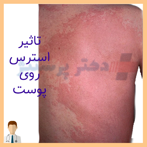 اثر استرس رو پوست دکتر پرستیژ